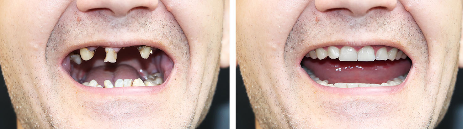 The image displays a person with multiple teeth missing, presented in a collage format showing different angles and expressions, including an open mouth revealing damaged teeth.