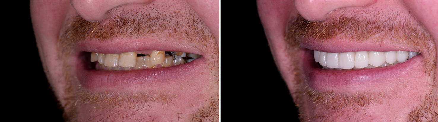 The image shows a person with a beard and mustache, smiling broadly with teeth showing, captured in two different positions side by side.